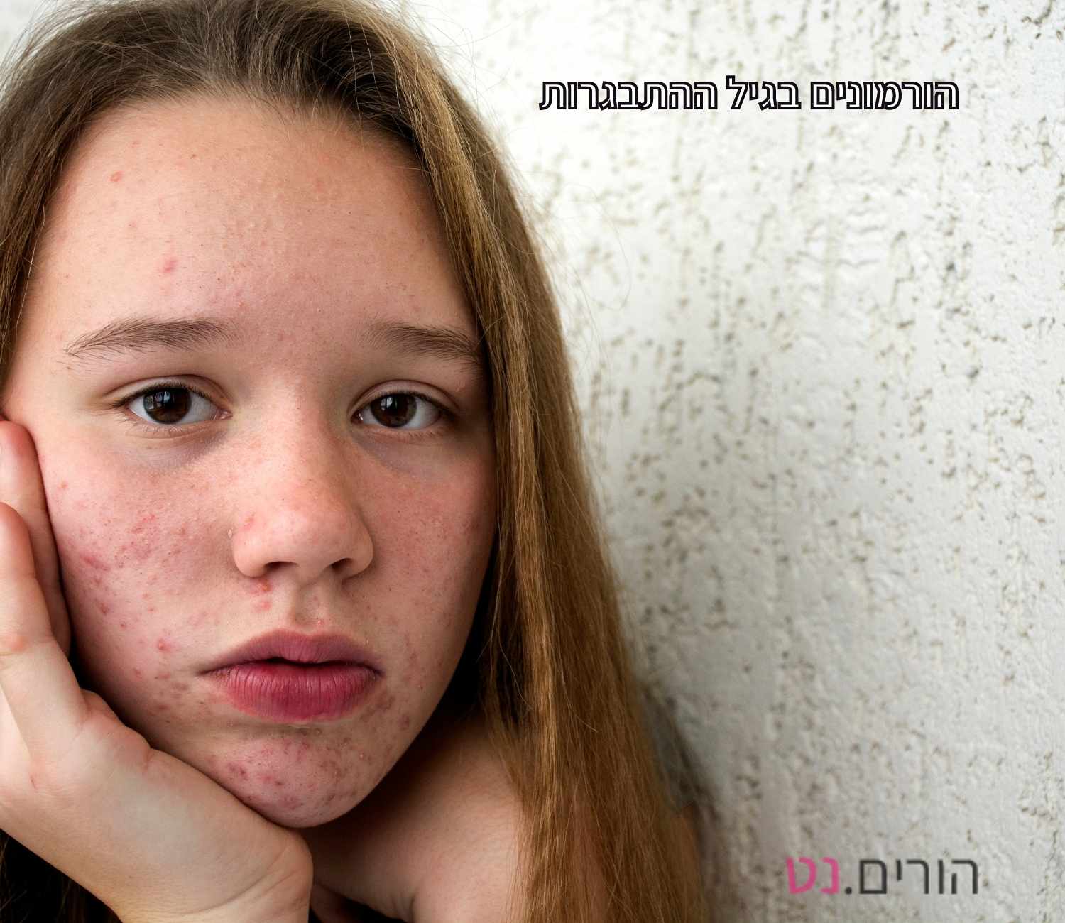 מתבגרת הורמונלית עם פצעים על הפנים